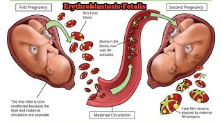 Erythroblastosis fetalis  Rh incompatibilityerythroblastosisfetalis [upl. by Lulita]