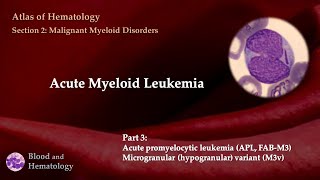 Acute Myeloid Leukemia AML  Part 3 [upl. by Lolita26]