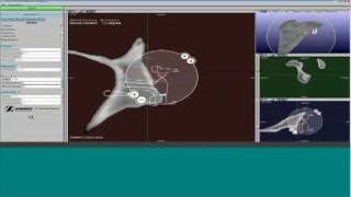 Preoperative virtual planning of the glenoid component implantation [upl. by Sane229]