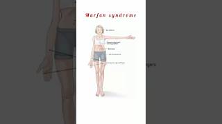 Marfan Syndrome kattrucate medicalreels marfansyndrome kyphosis scoliosis tall stature [upl. by Selfridge493]