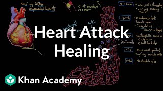 Healing after a heart attack myocardial infarction  NCLEXRN  Khan Academy [upl. by Yesdnyl]