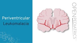 quotPeriventricular Leukomalaciaquot by Anne Hansen MD MPH for OPENPediatrics [upl. by Caiaphas711]