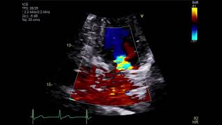 Transthoracic echocardiogram showing four chamber focused view with color doppler [upl. by Delores]