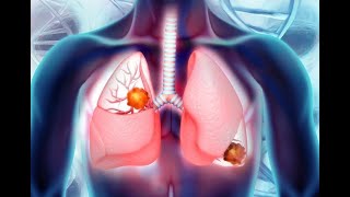 CARCINOID TUMORS OF THE LUNG Lung Carcinoid Signs Symptoms Pathology [upl. by Feilak23]