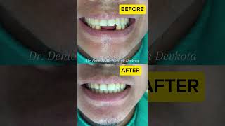 Replacing missing front teethRemovable partial dentureDr Swostik Devkota Esthetic Transformation [upl. by Varney237]