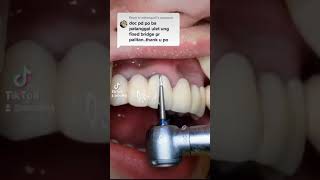 How to REMOVE OLD FIXED BRIDGE dentalbridge dentaltips denture [upl. by Katine]