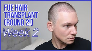 WEEK 2  FUE Hair Transplant Round 2  Removing Scabs and Losing Hair Shafts [upl. by Branscum]