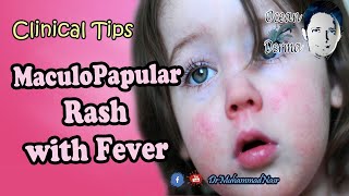 MaculoPapular Rash with Fever  Ocean Derma  Clinical Tips [upl. by Doralynne]