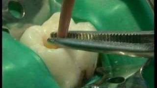 Endodontie mécanisée le système PROTAPER® principes et guide dutilisation [upl. by Harihs]