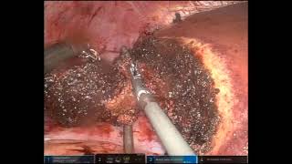 Simultaneous Robotic Right Colectomy with Intracorporeal Anastomosis and Partial Hepatectomy [upl. by Ylehsa]