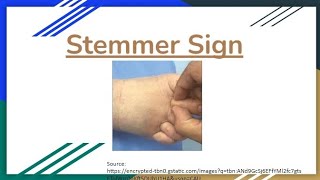 Stemmers Sign in Lymphedema A Key Diagnostic Indicator Explained [upl. by Aznola]