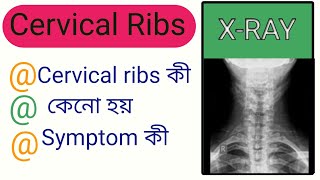 Cervical ribs কী [upl. by Phalan]