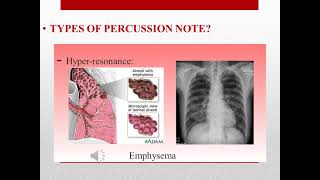 Examination of the chest Percussion  By Dr Esraa Abdou الفرقة الخامسة [upl. by Notnroht]