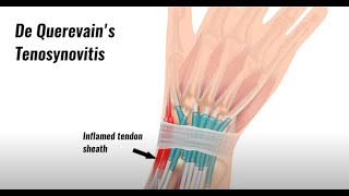 Finkelsteins test for wrist pain Special Test of Wrist [upl. by Cesaria125]