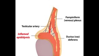 Epididymitis [upl. by Hiller]