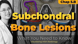 Chapter 5 B⎜Subchondral bone lesions ⎜Knee MRI⎜Visualizing MSK Radiology⎜Refer to timeline [upl. by Osbourne]