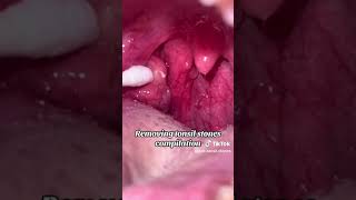 tonsil stones compilation [upl. by Manthei]