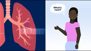 What Happens After Your Doctor Finds a Lung Nodule Pulmonary Nodule [upl. by Oigile]