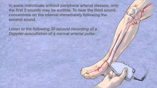 Doppler Auscultation of the Posterior Tibial Artery [upl. by Tenner601]