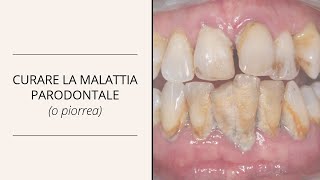 COME SI CURA LA MALATTIA PARODONTALE [upl. by Cornell]