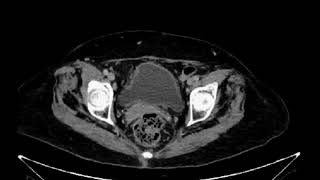 Px con adenocarcinoma de pulmón metastásico se solicita estudio para valorar de respuesta a tx [upl. by Aniluj771]