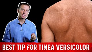 Natural Skin Fungus Tinea Versicolor Home Remedies – Dr Berg [upl. by Luella107]