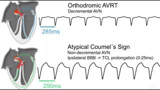 Coumel sign in AVNRT [upl. by Neyut]