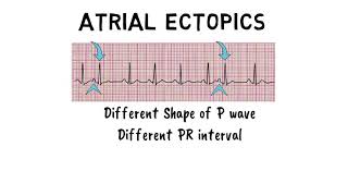 ATRIAL ECTOPICS [upl. by Wendeline]