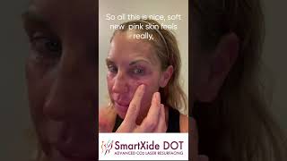 Getting Started  SmartXIDE DOT CO2 Laser Skin Resurfacing Day by Day Actual Patient Live Video [upl. by Girish259]