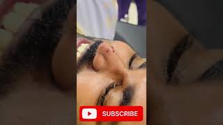 Laser Mole Removal  Mole तिल kaise nikale shortvideo viral doctor hospital skincare mole [upl. by Netsruk243]