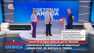 Doktorum Yanımda  Vücuttaki morluklar neden oluşur  Prof Dr Mustafa Nuri Yenerel  17 03 2021 [upl. by Bartel]