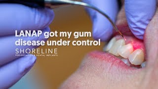 Treat periodontal disease with less pain Dr Urbanski explains the LANAP procedure [upl. by Nichole]