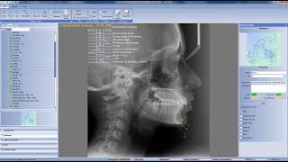 TIPS for making cephalometric analysis in Planmeca Romexis 35 and newer [upl. by Togram]