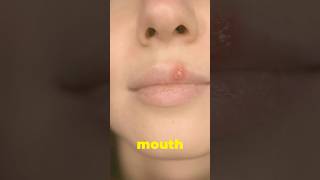 “Quick Tips To Manage Mouth Ulcers “ [upl. by Yasdnil325]