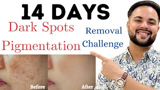 14 Days Dark Spots amp Pigmentation Removal Challenge  100 Results [upl. by Decrem57]