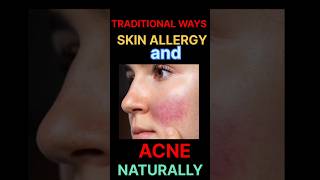 Traditional way To acne careglowing skin increase skin collagennaturalcare  beauty careskin [upl. by Eckblad]