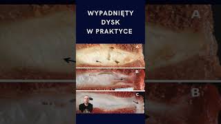 Dysk mi wypadł [upl. by Alasdair]