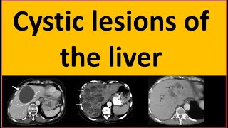 Differential diagnosis of cystic lesions of the liver [upl. by Gorey]