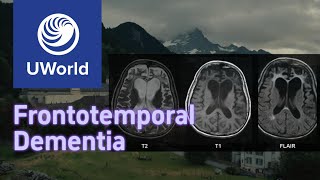 Frontotemporal Dementia vs Alzheimer Disease with Histology  UWorld USMLE MBBS [upl. by Eninnaej62]