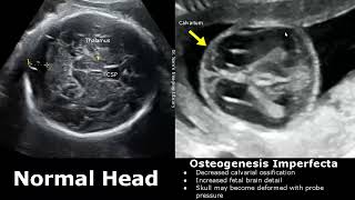 Fetal Musculoskeletal Ultrasound Normal Vs Abnormal Image Appearances  Skeletal Dysplasias MSK USG [upl. by Rocker]