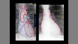 Radiografía de Tórax [upl. by Davey]