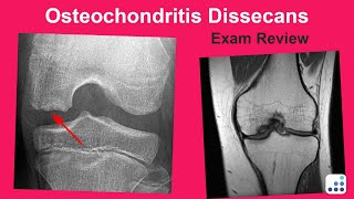 Osteochondritis Dissecans Exam Review  Mark Pagnano MD [upl. by O'Connor574]