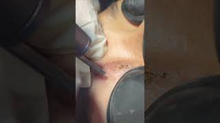 Linear Epidermal Nevus Removal By CO2 Laser [upl. by Enelam]