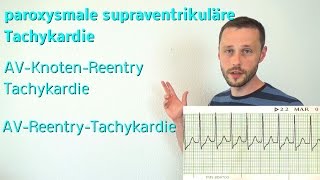 Die supraventrikuläre Tachykardie AVKnotenReentry und AVReentryTachykardie [upl. by Dez]