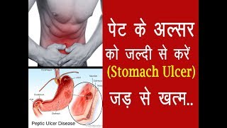 पेट के अल्सर को करें जड़ से ख़त्म Peptic Ulcer Treatment at Home [upl. by Ellehcram40]