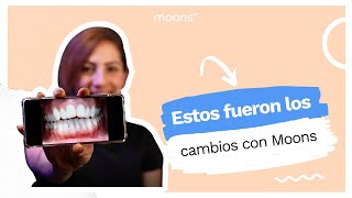 Opiniones Moons  Daniela comparte cómo vio los cambios en sus dientes usando Moons [upl. by Rehpotsirc713]