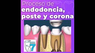 proceso de endodoncia [upl. by Carolyne]