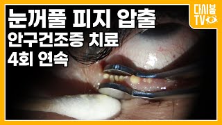 눈 피지 압출  안구건조증  눈꺼풀 염증 치료 [upl. by Einnal]