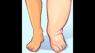 How to Improve Lymphedema Lose Weight and Feel Better More Often A Free Webinar [upl. by Suiluj144]