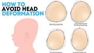 Correct Sleeping Position for Each Stage for Infants to Avoid Head Deformation  flat head syndrome [upl. by Zurheide]